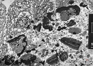 M,66y. | follicular cyst with hyaline Rushton bodies